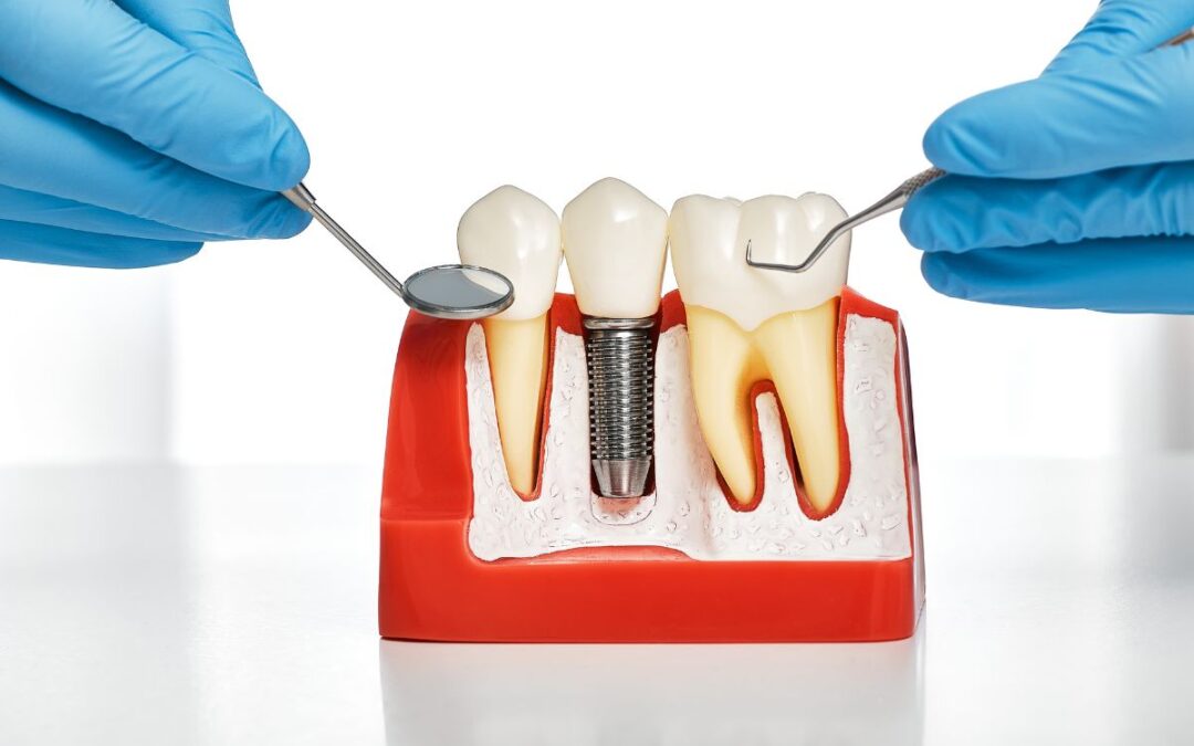 Planning to Feast This Independence Day? Don’t Let Missing Teeth Hold You Back