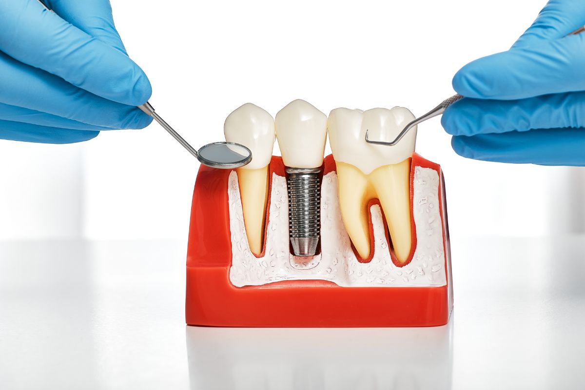 dental implants dental implants panama city