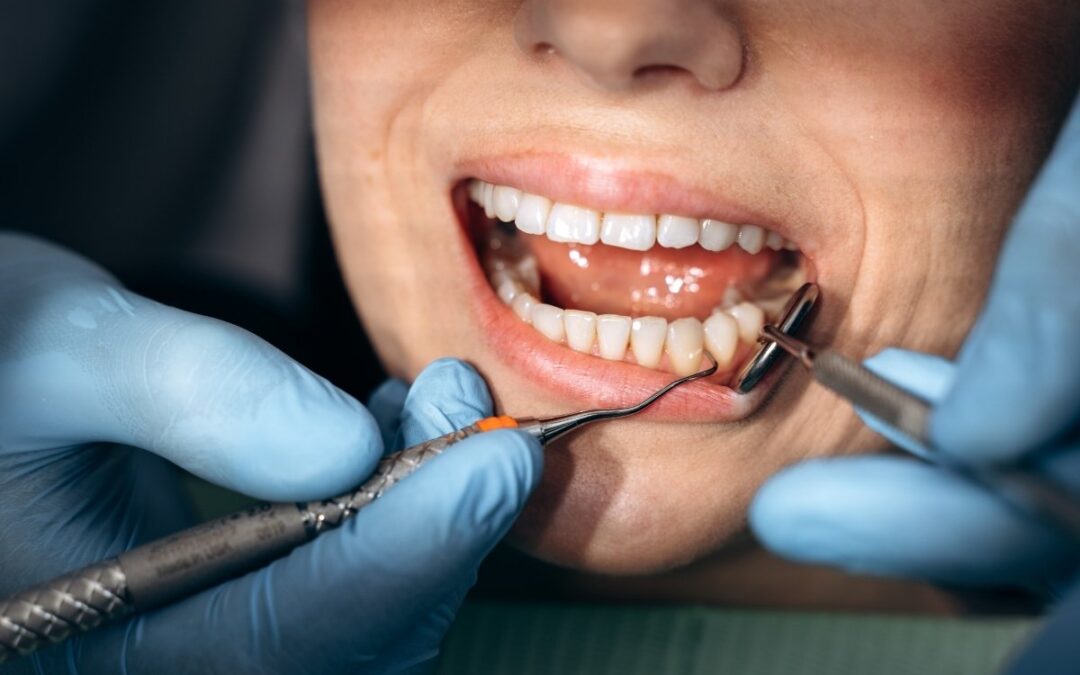 The Gap Between Your Dental Crown And Gums: How To Fix It?