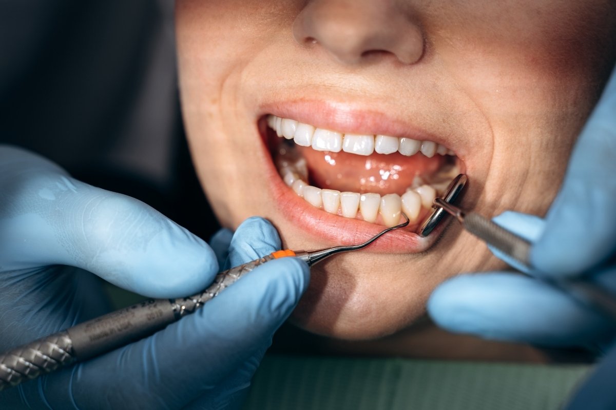Between Your Dental Crown And Gums Between Your Dental Crown And Gums
