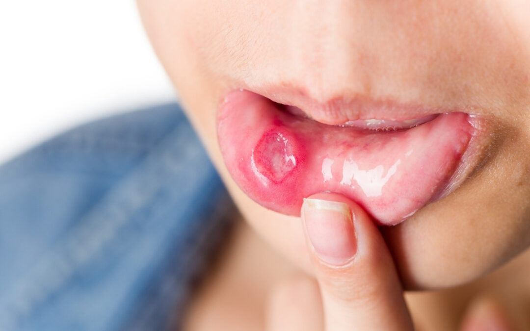 How to Get Rid of Mouth Ulcers Overnight: Effective Tips and Remedies