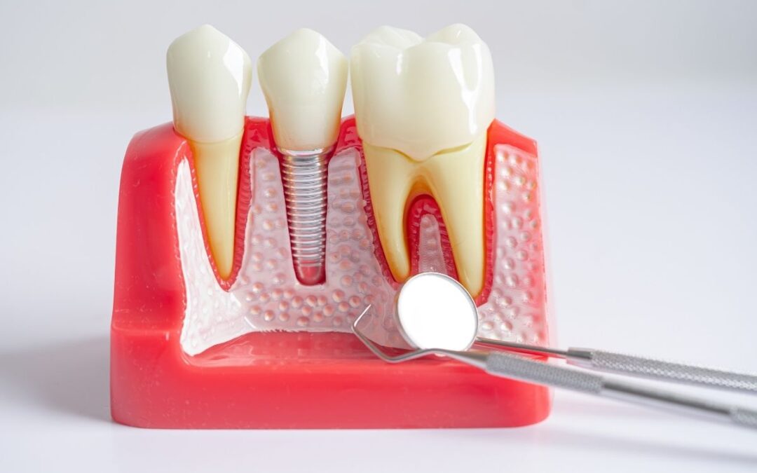 What Is the Dental Implant Process? Step-by-Step Guide for Patient