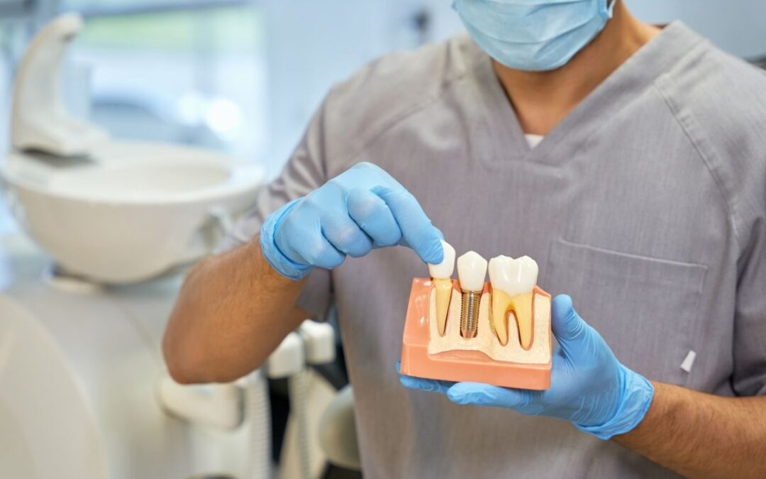 What Are Full Mouth Dental Implants and How Do They Work?