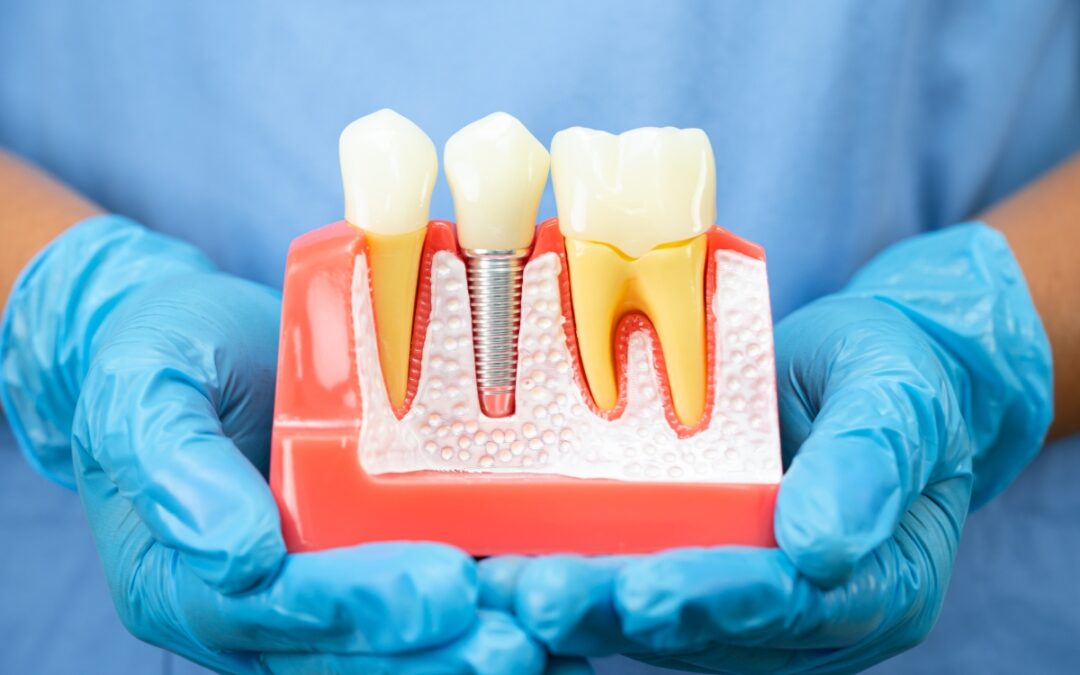 Should You Remove Healthy Teeth to Get Dental Implants?