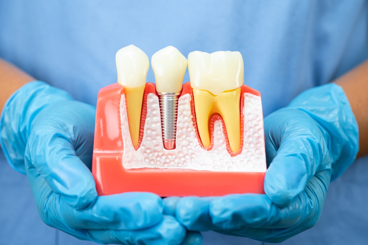 dental implants in Panama City
