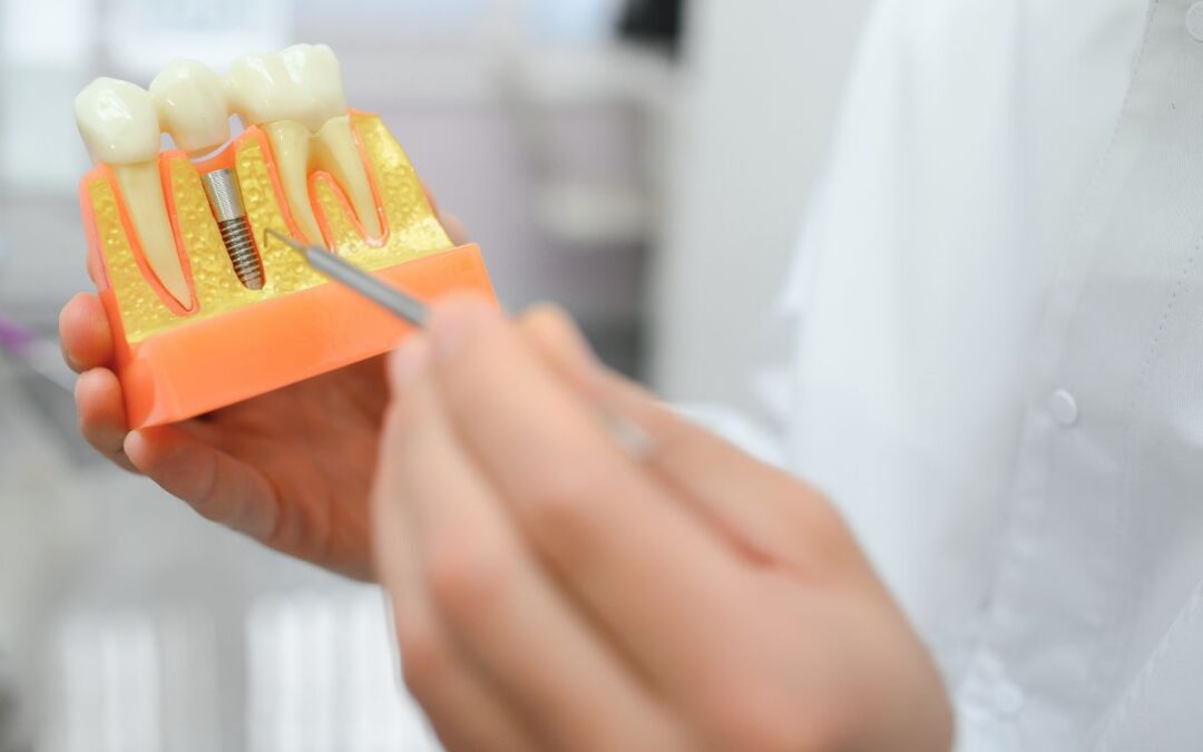 How Bacterial Exposure May Affect Dental Implant Outcomes
