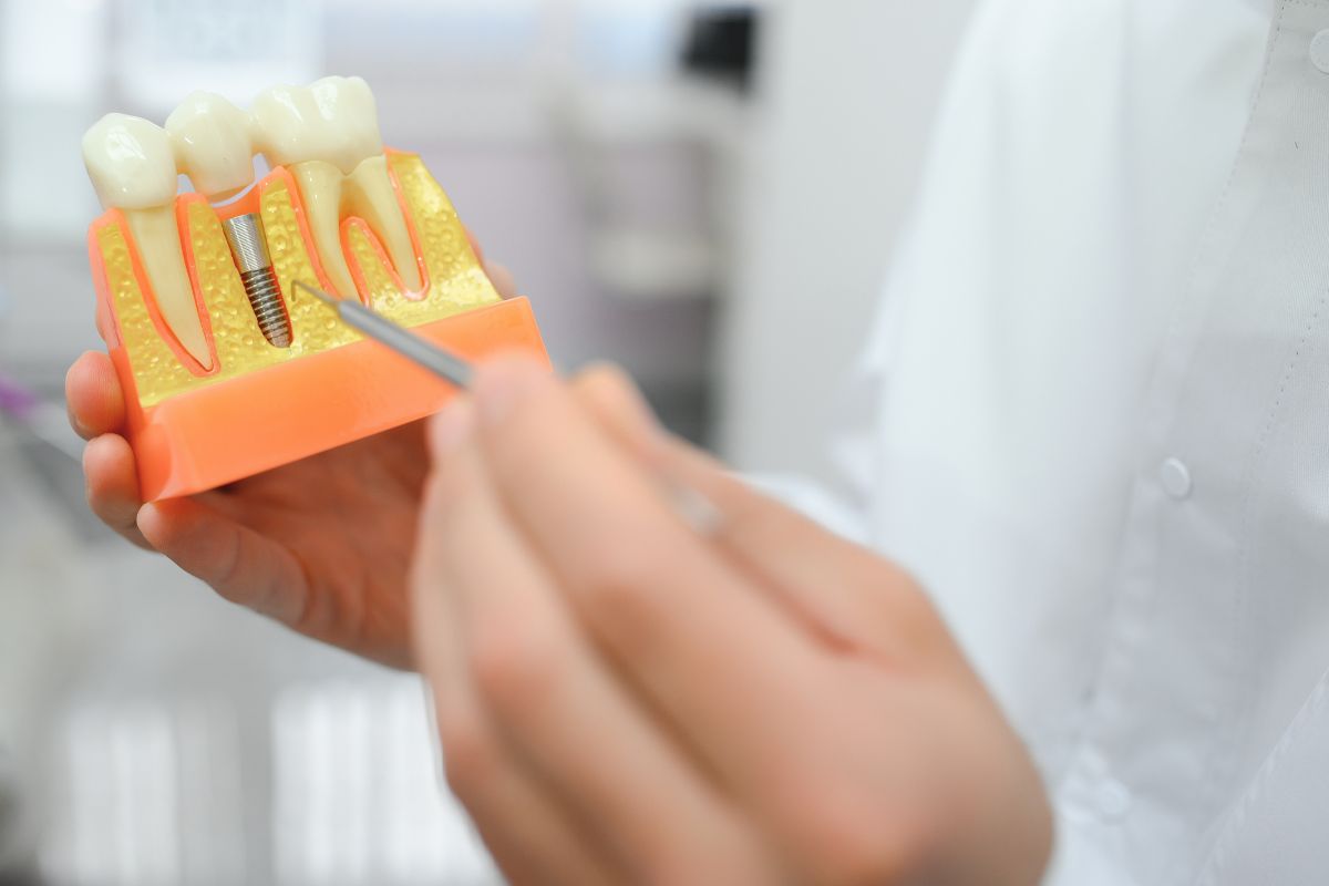 Dental Implant Dental Implant
