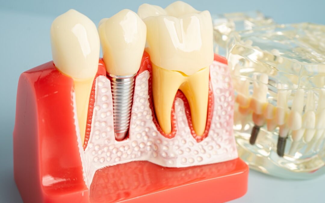 How Long After Tooth Loss Can You Get a Dental Implant?