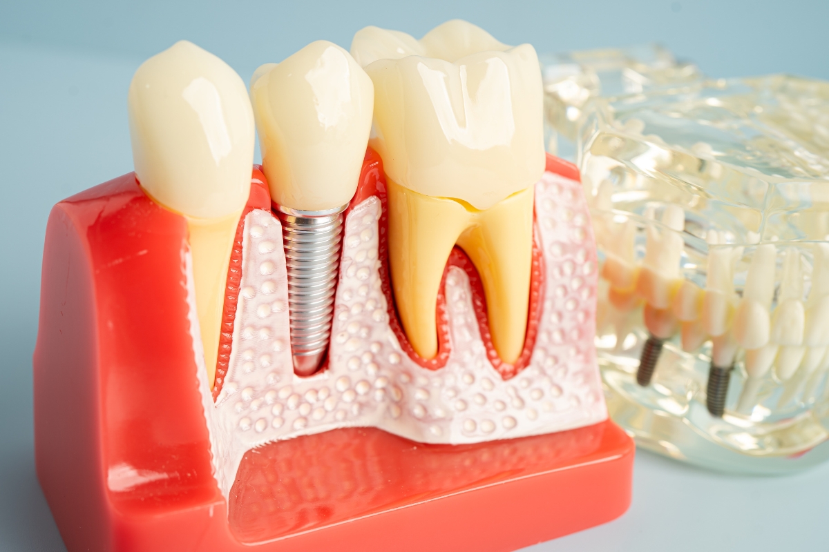 dental implants dental implant, implant dentist panama city, dental implants panama city, dental implants in panama city