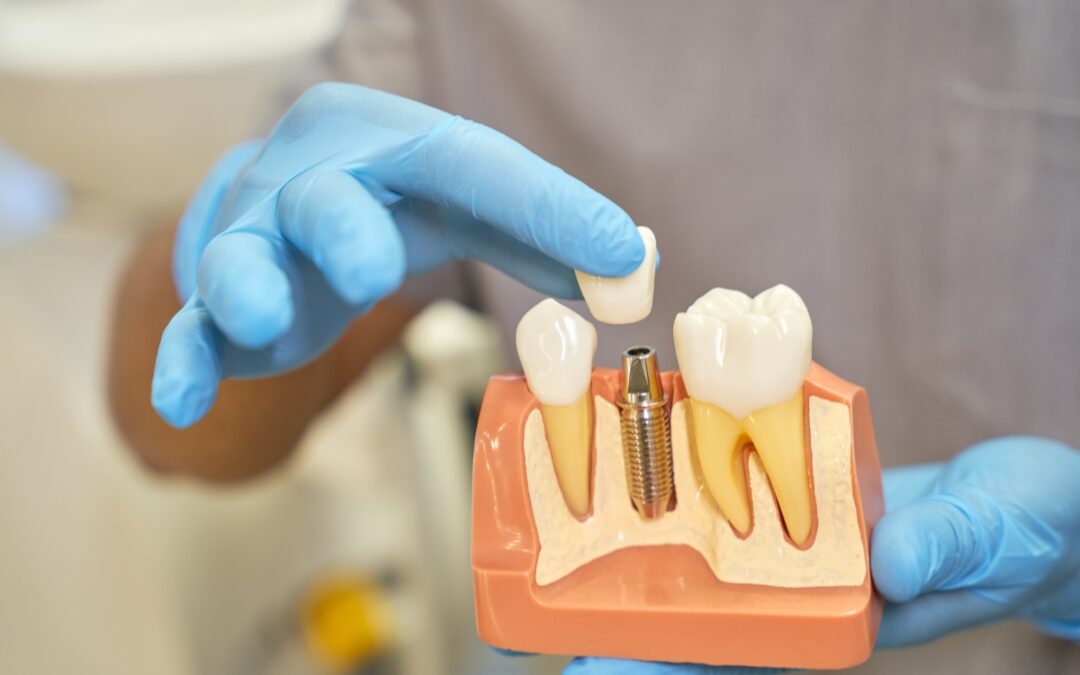 Can Dental Implants Prevent Bone Loss? A Panama City Dental Guide