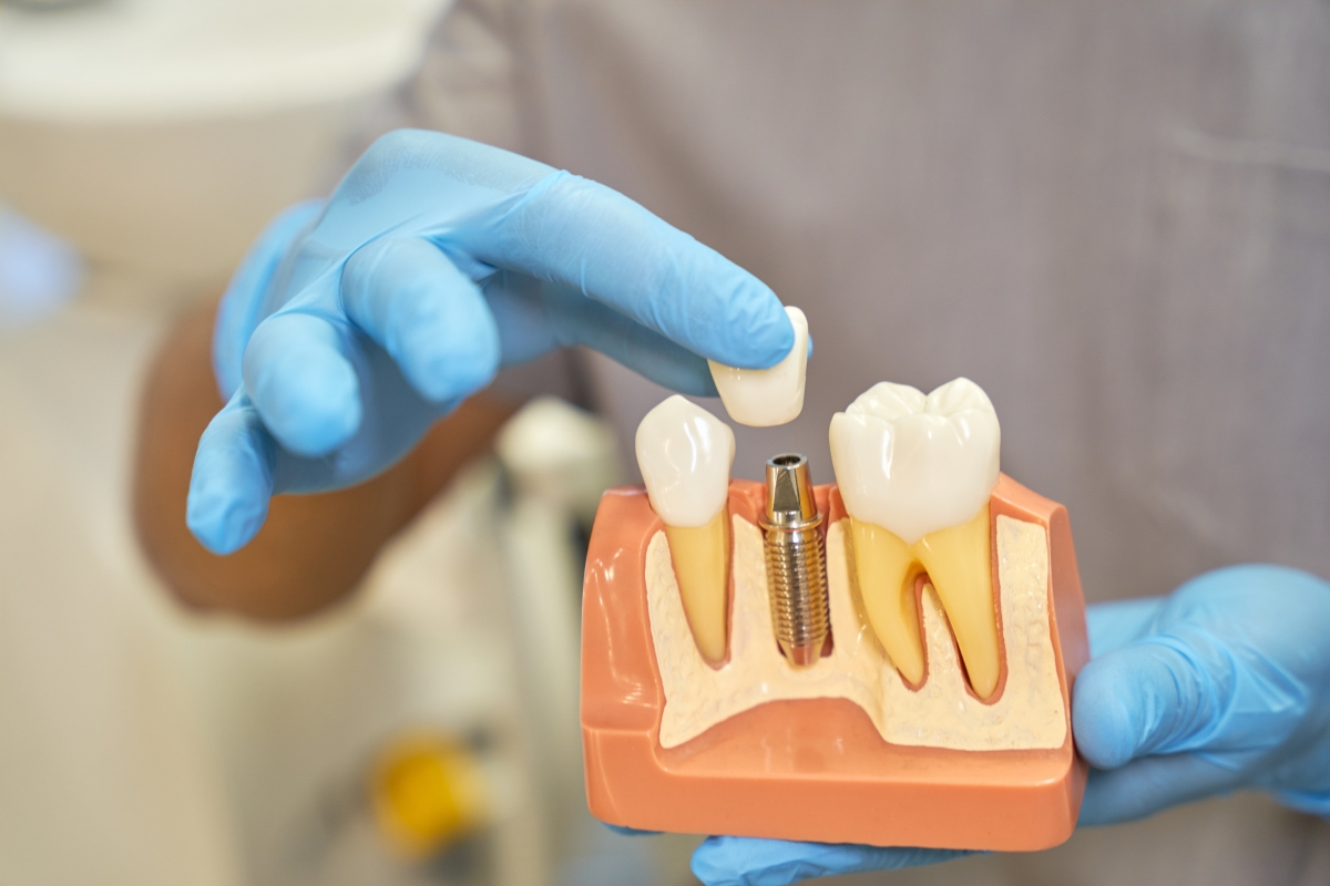 Dental Implants Prevent Bone Loss Dental Implants Prevent Bone Loss
